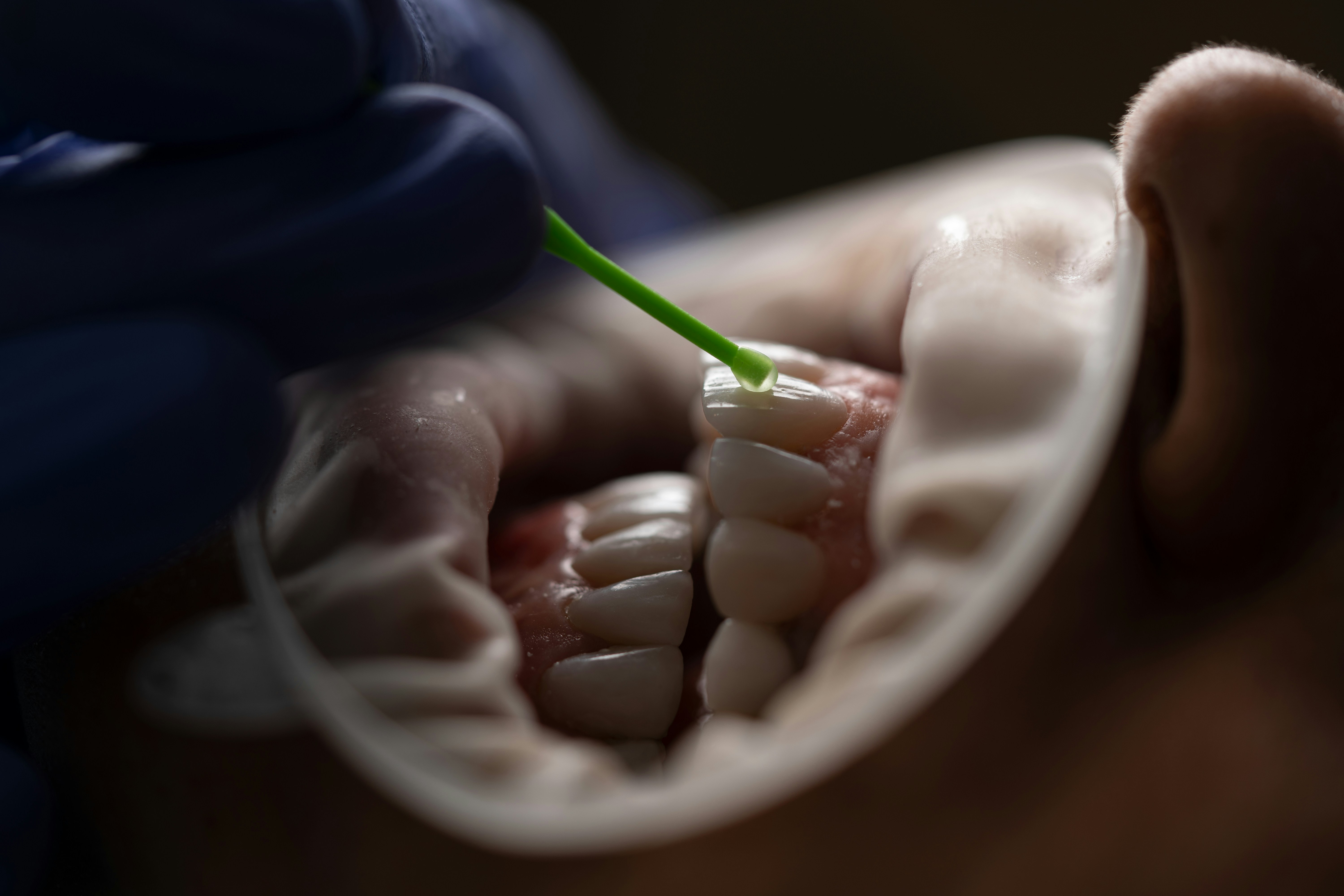 Esthetic Rehabilitation