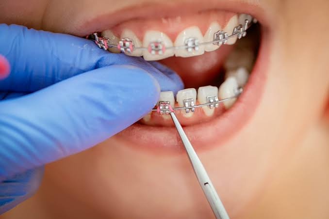 Braces & Orthodontics